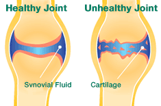 Healthy Joint Comparison